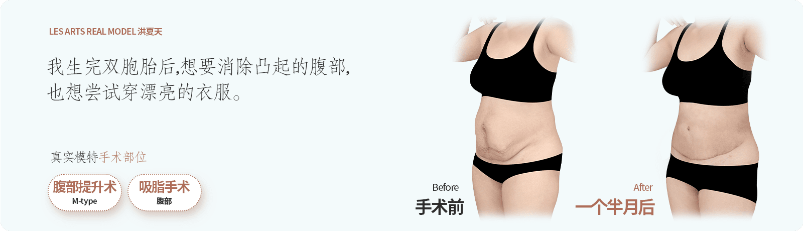 복부거상,지방흡입한 리얼모델