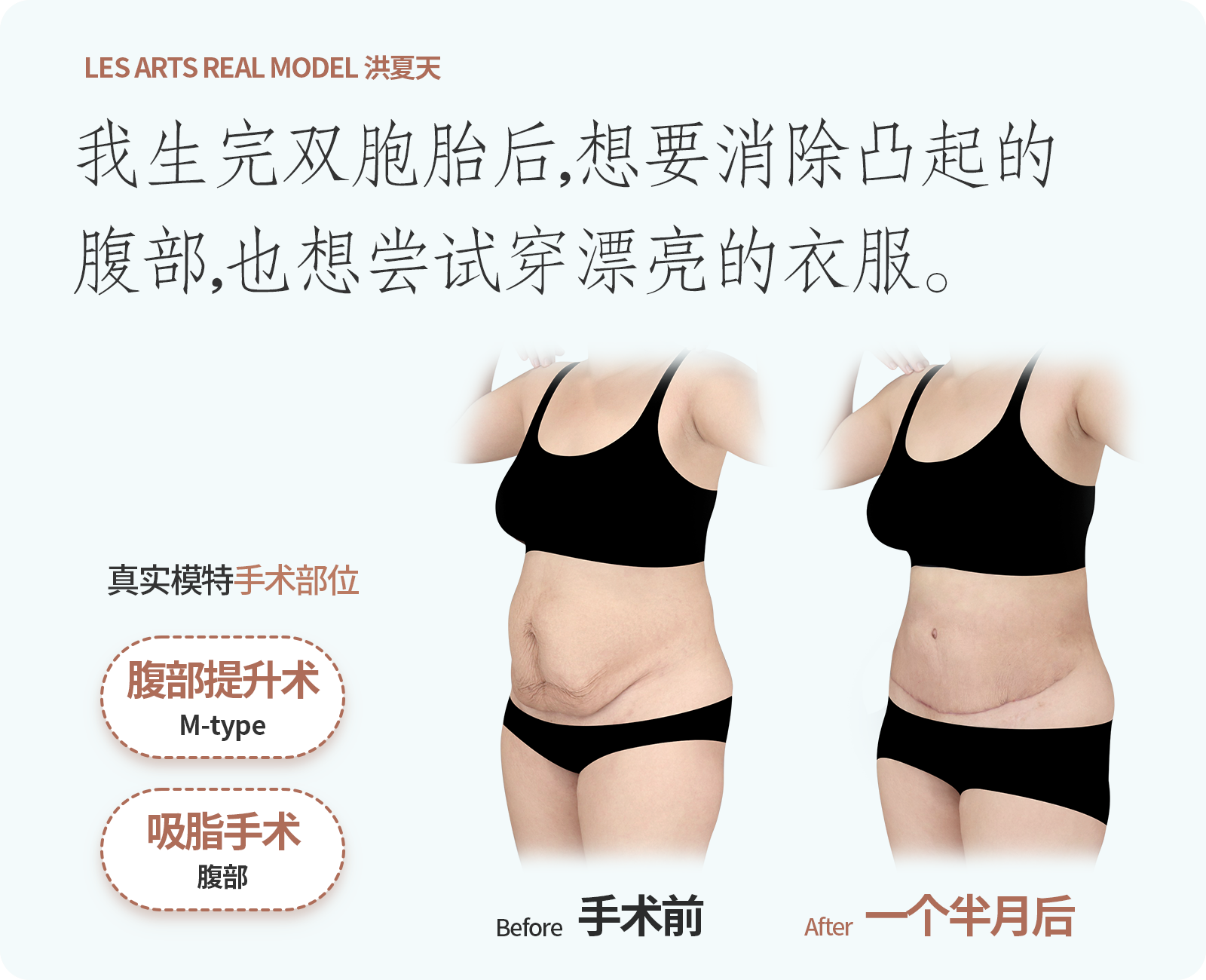 복부거상,지방흡입한 리얼모델
